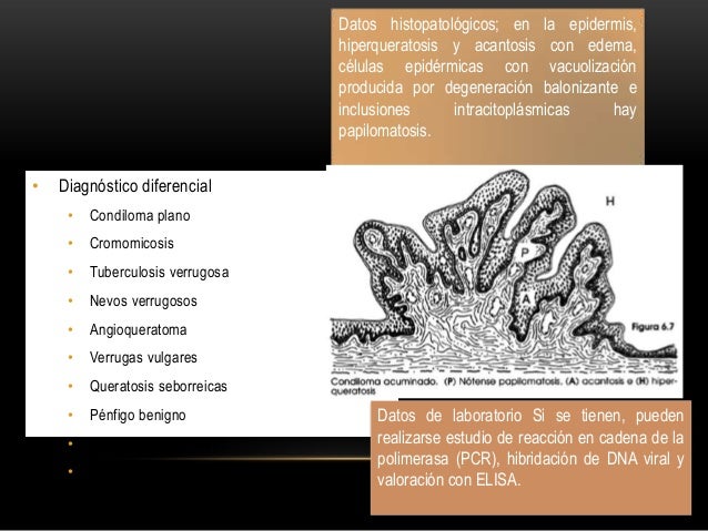 Condilomatosis Pdf